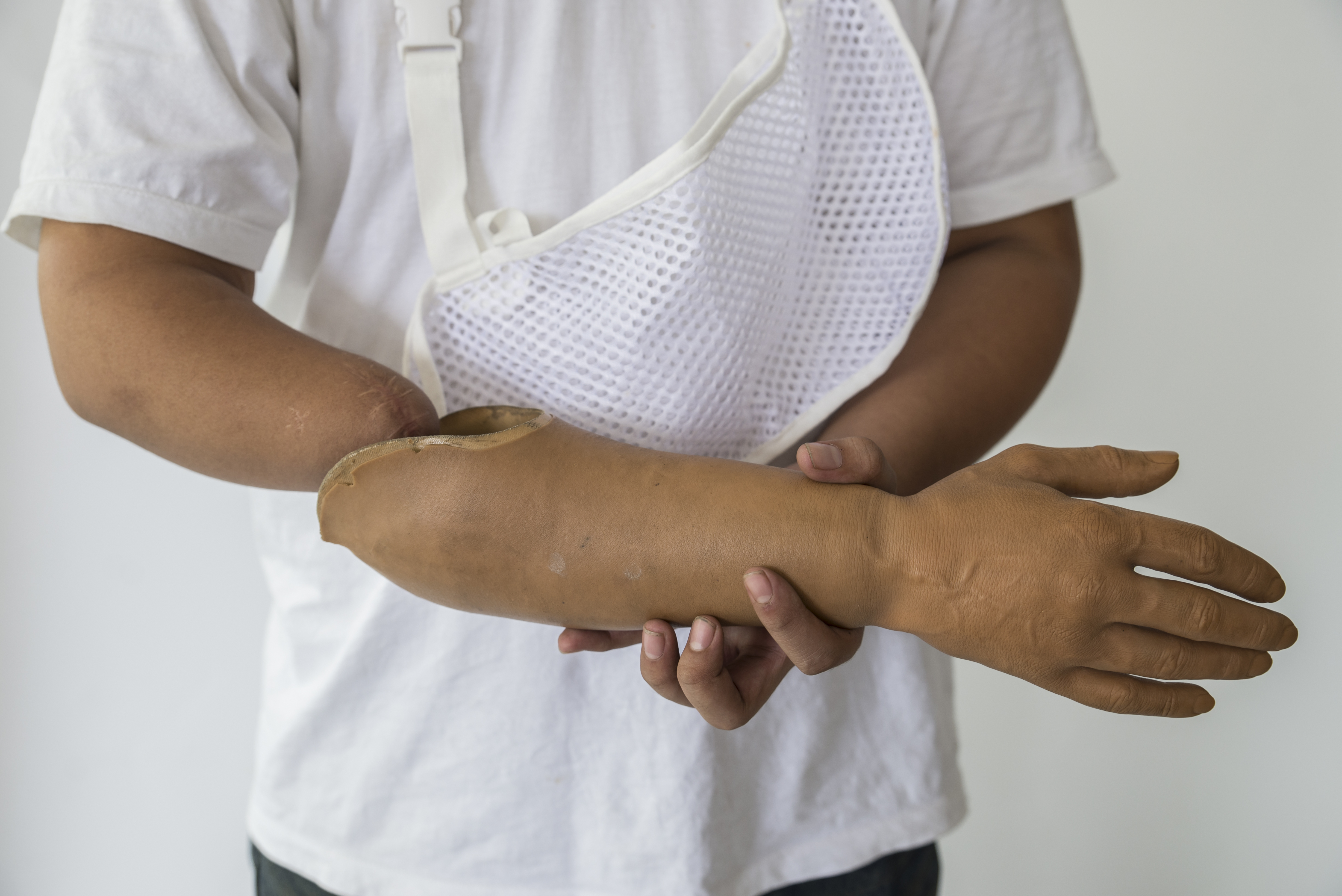 Silikon Kol Protezi - ORTHOGEZ